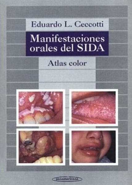 MANIFESTACIONES ORALES DEL SIDA (1995)
